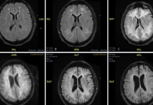 Estudo aponta que Covid-19 pode envelhecer o cérebro 10 anos